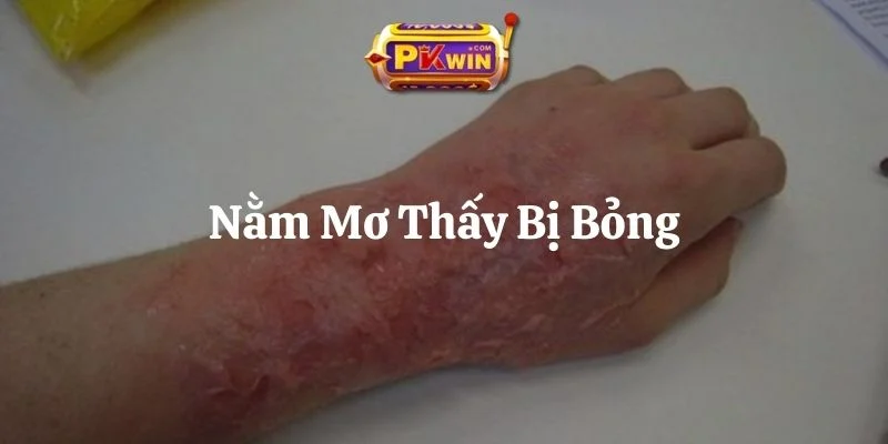 Nằm Mơ Thấy Bị Bỏng – Luận Giải Ý Nghĩa & 7 Bộ Số May Mắn