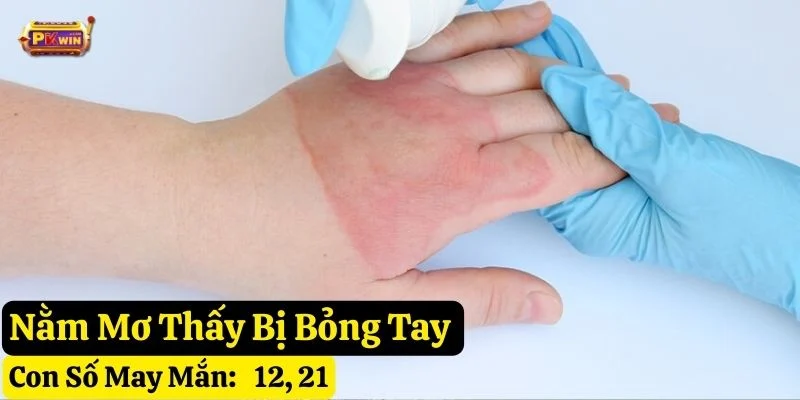 nằm mơ thấy bị bỏng