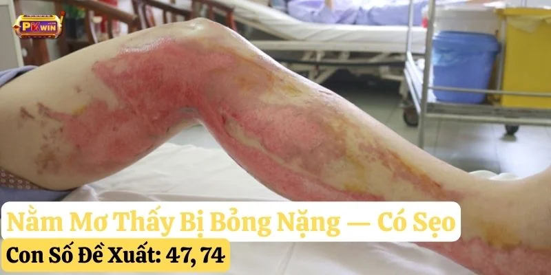 mơ thấy bị bỏng