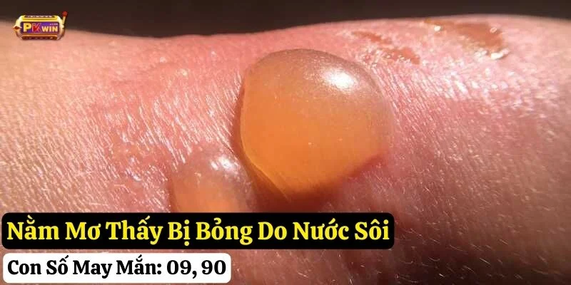 mơ bị bỏng